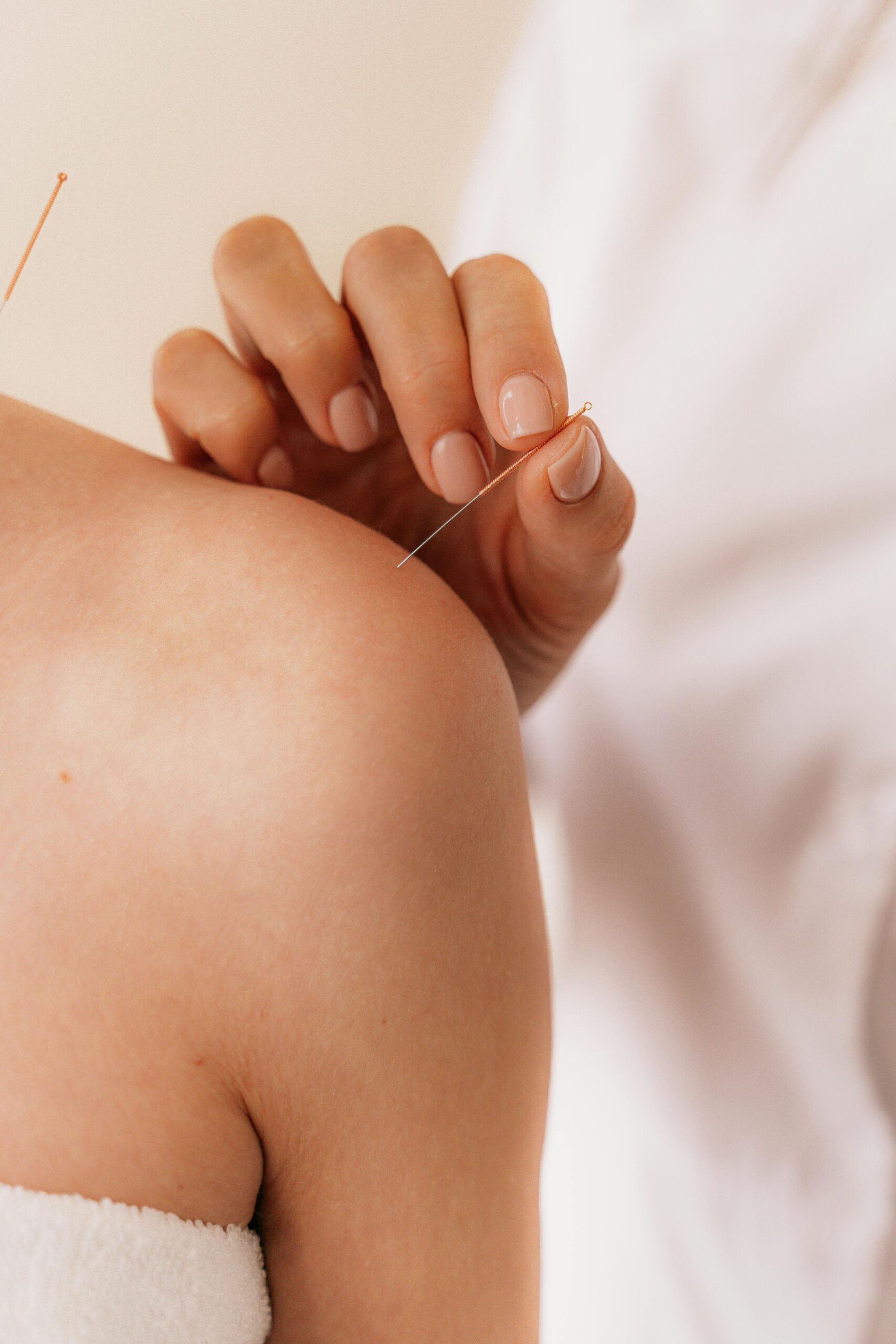 Acupuncturist inserting thin needles at specific points on a patient's body during treatment.